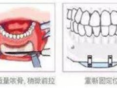 垫下巴假体(隆下巴的方式有哪些？)