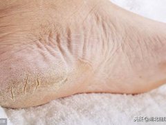 脚底皮肤粗糙(怎样防止脚皮粗糙？)
