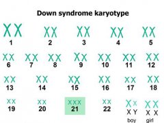 唐氏综合症是什么？(什么是唐氏综合征？)