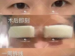 全割双眼皮(案例｜全切双眼皮四个月分享)