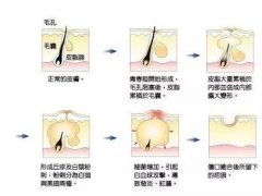 脸上长小疙瘩很痒(脸上长痘痘发痒的原因)