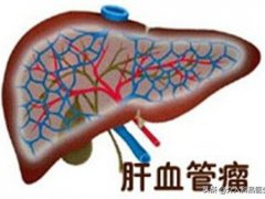 肝脏血管瘤怎么治(肝血管瘤如何治疗？)