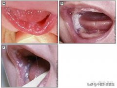 鹅口疮怎么治疗？(鹅口疮有哪些治疗方法？)