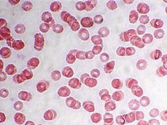 白血球减少症(白细胞减少是什么病)